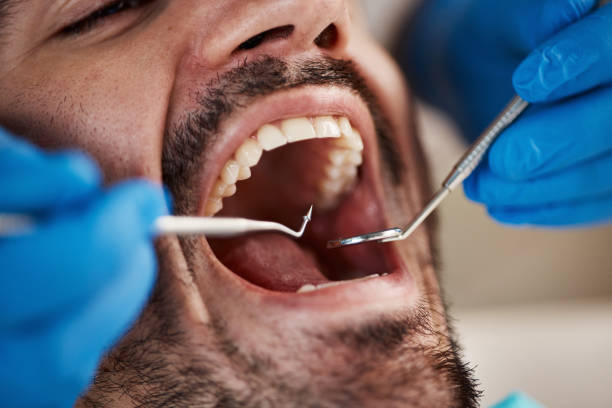 Best Emergency Dental Extractions in Lake Dunlap, TX